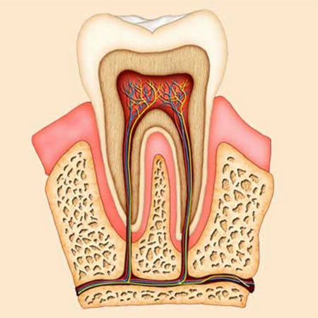 Dental caries treatments Root canal treatment in Hyderabad