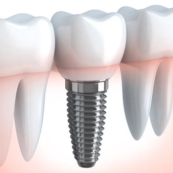 Dental Implants in Hyderabad