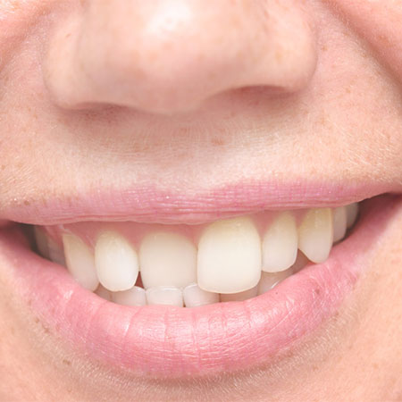 Irregular teeth correction without braces