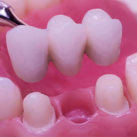 Replacement of missing teeth with fixed & removable dentures