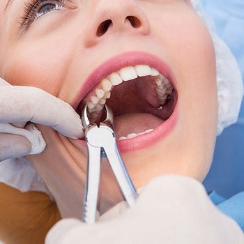 Wisdom teeth surgery in SR nagar